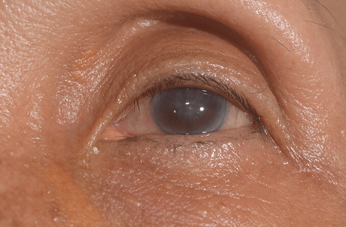closeup of an eye with corneal edema