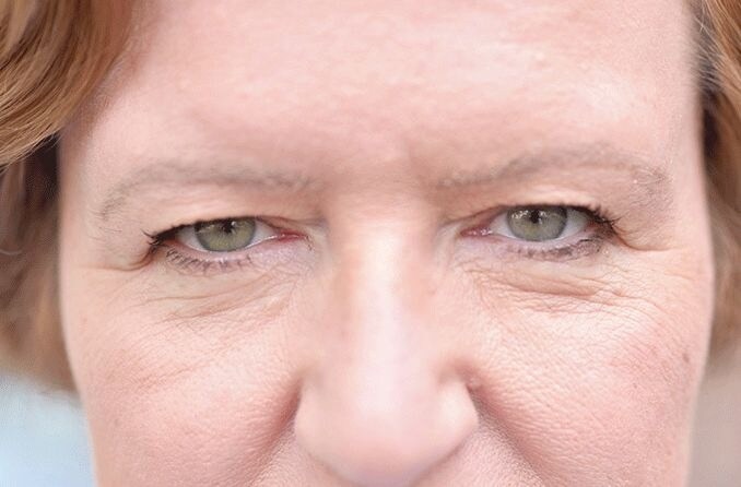 woman with dermatochalasis