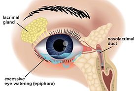 illustration of epiphora (excessive eye tearing or watering)