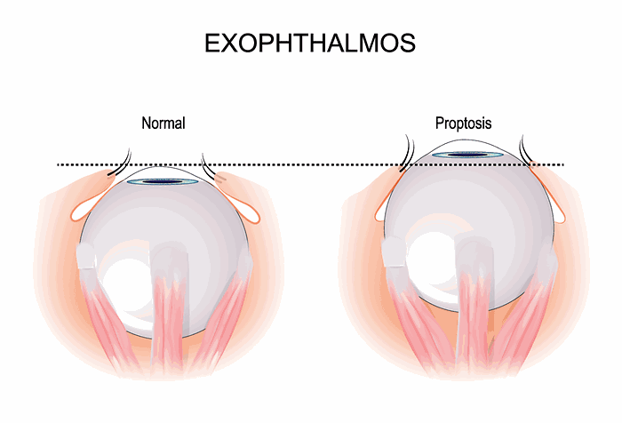 Exophthalmos (bulging eyes)