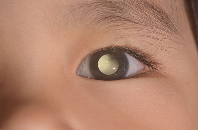 closeup of a child's eye with leukocoria