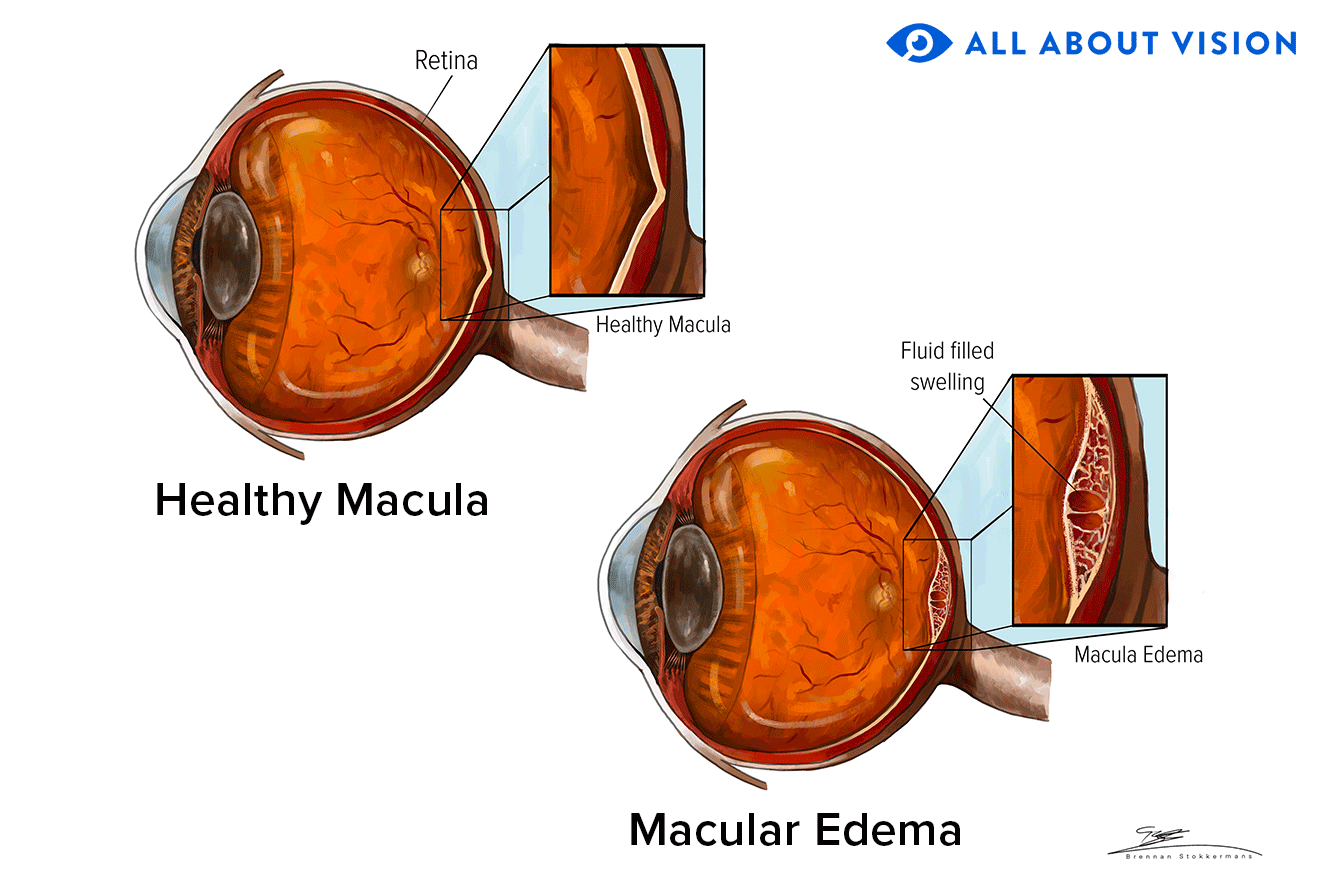 Comparison between a healthy macula and macular edema Comparison between a healthy macula and macular edema