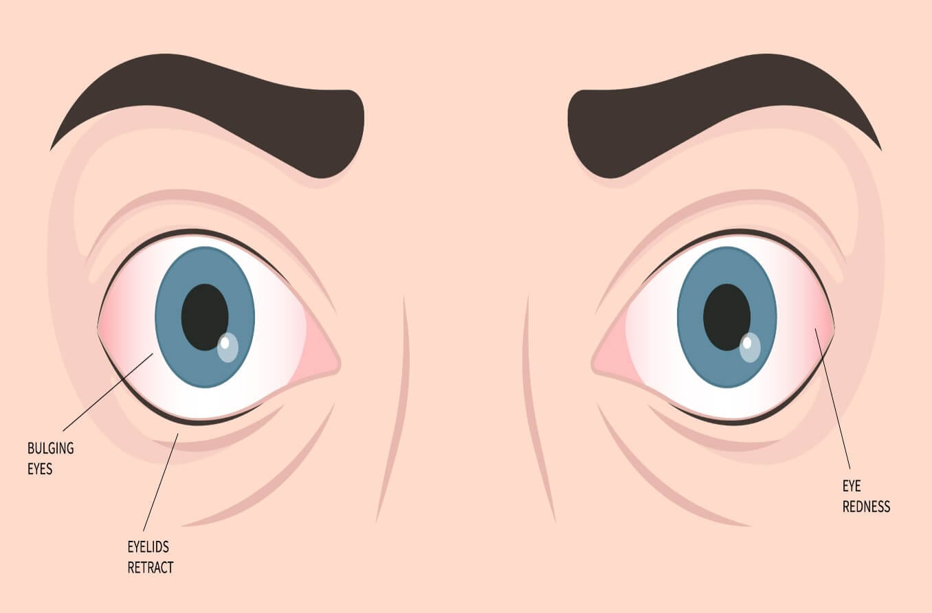 Characteristics of orbital pseudotumor include bulging eyes, eye redness, and retracted eyelids. 