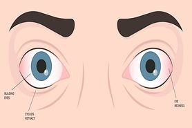 Orbital pseudotumor: Causes, symptoms and treatment Orbital pseudotumor: Causes, symptoms and treatment