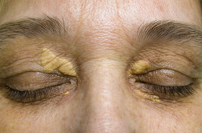 closeup of eyes with xanthelasma