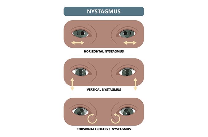 illustration of the 3 types of nystagmus