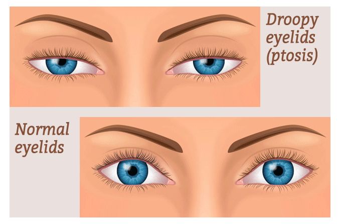 illustration of droopy eyelids (ptosis) vs. normal eyelids illustration of droopy eyelids (ptosis) vs. normal eyelids