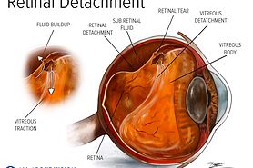 illustration of a detached retina
