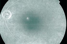 Fluorangiography showing left eye with central serous chorioretinopathy Fluorangiography showing left eye with central serous chorioretinopathy
