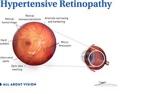 hypertensive retinopathy medical illustration.