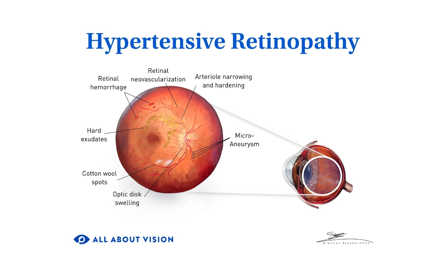 hypertensive retinopathy medical illustration.