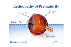 Normal eye v eye with retinopathy of prematurity.