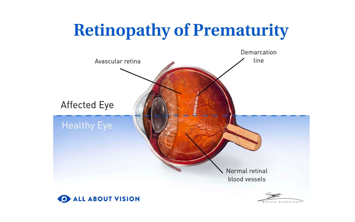 Normal eye v eye with retinopathy of prematurity.