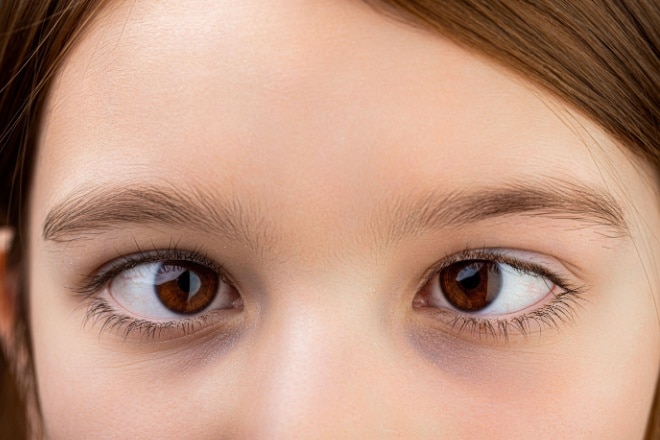 illustration of hypertopia (type of strabismus)