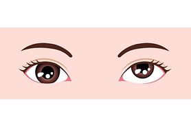 illustration of hypertopia (type of strabismus)