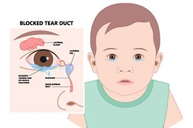 illustration of blocked tear ducts in babies