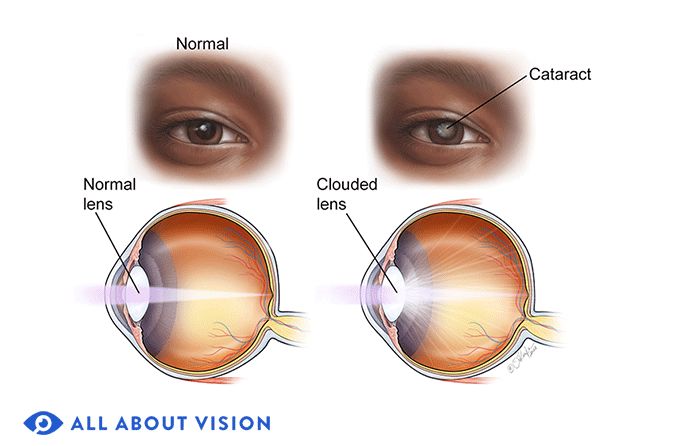 normal eye vs eye with cataract normal eye vs eye with cataract