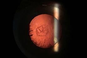 Posterior subcapsular cataract