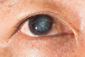 closeup of an eye with a traumatic cataract