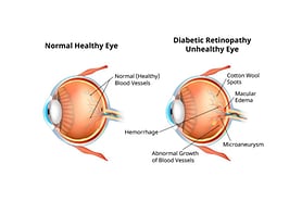 diabetic retinopathy eye diagram
