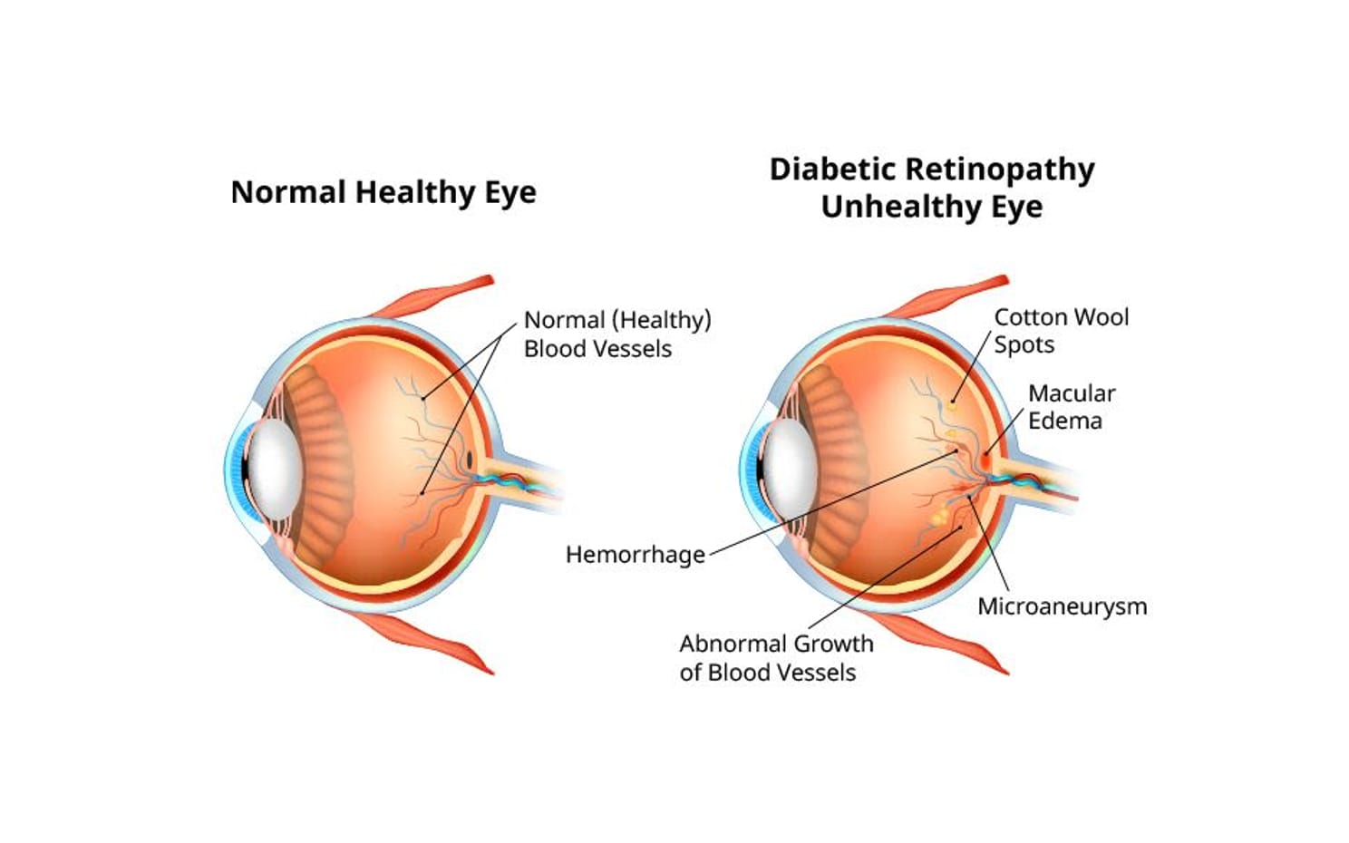 diabetic retinopathy eye diagram