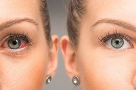 side by side image of normal eye vs dry eye