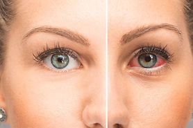 side by side image of normal eye vs dry eye