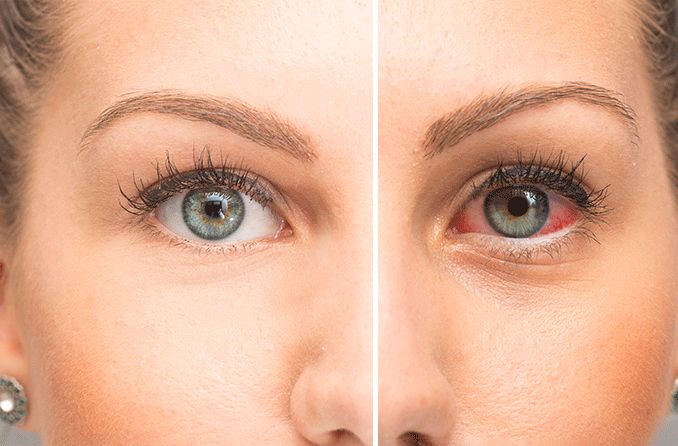 side by side image of normal eye vs dry eye side by side image of normal eye vs dry eye