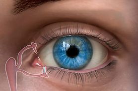 illustration of punctal plug in an eye