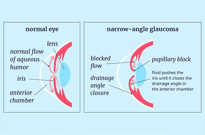 illustration of a regular eye vs eye with narrow angle glaucoma illustration of a regular eye vs eye with narrow angle glaucoma