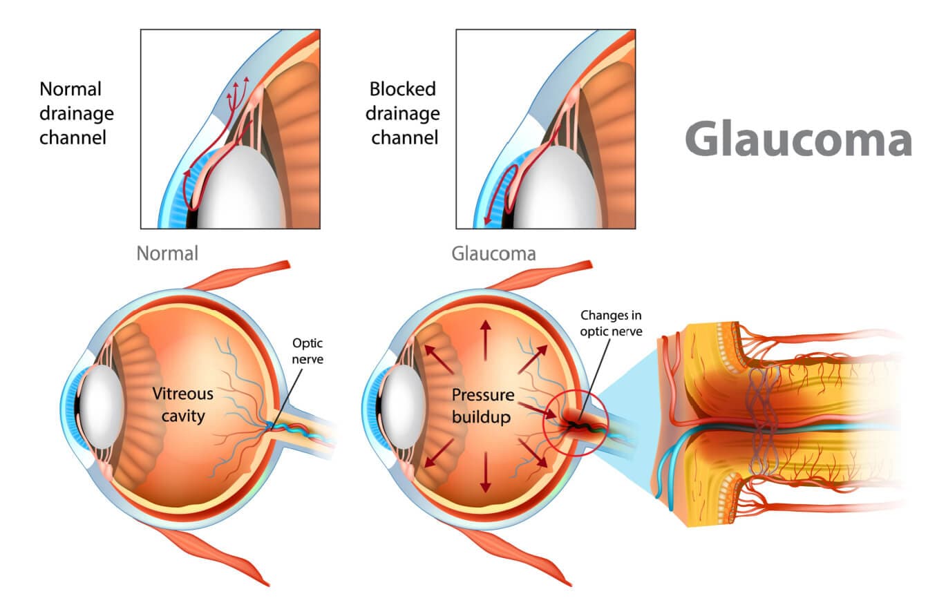 Illustration of a normal eye v eye with glaucoma. Illustration of a normal eye v eye with glaucoma.