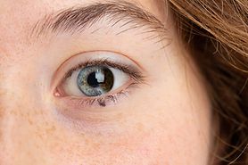 What is partial heterochromia? What is partial heterochromia?