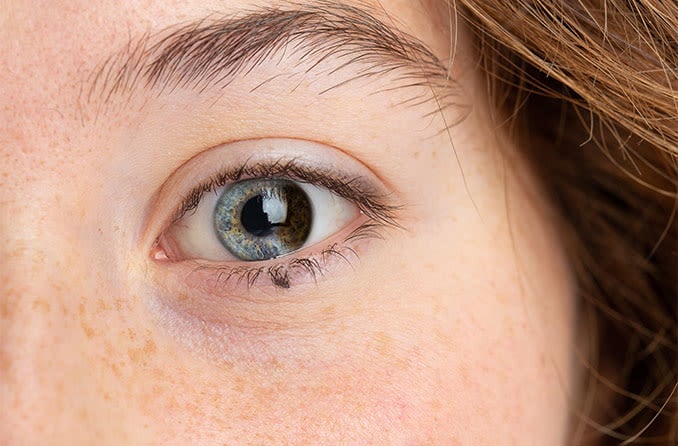 closeup of a woman's eye with partial or sectoral heterochromia closeup of a woman's eye with partial or sectoral heterochromia