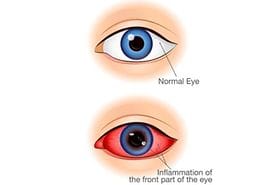 Comparison between eyes that have the symptoms of anterior uveitis and normal eyes.