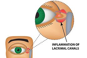 illustration of canaliculitis which is the inflammation of the lacrimal canals