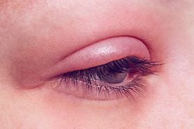 closeup of an eye infection