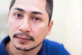 man with iridocyclitis in one eye