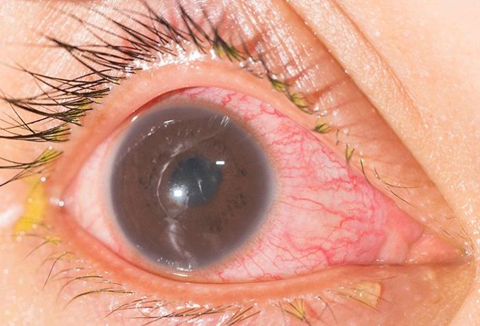 Iritis: Inflammation of the iris
