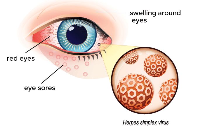 illustration of eye herpes and its symptoms illustration of eye herpes and its symptoms
