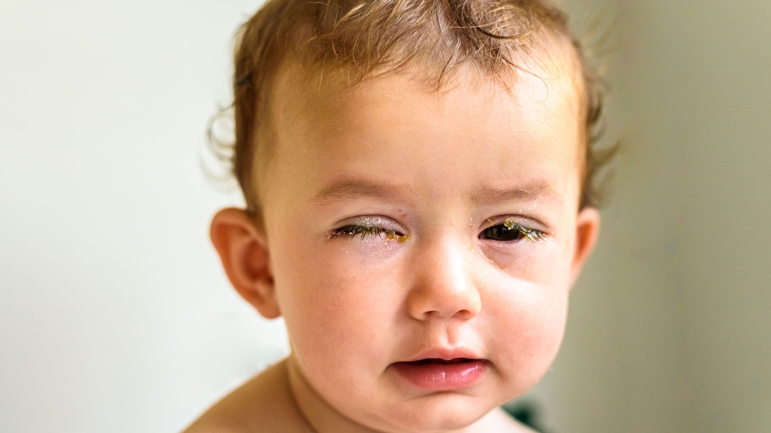 Young toddler with swollen, crusted eyes from conjunctivitis