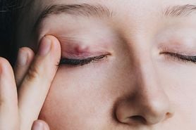 Young girl shows a chalazion on the eyelid closeup.
