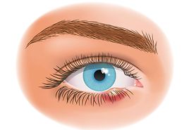 eyeball illustration of a stye (hordeolum) on the lower eyelid