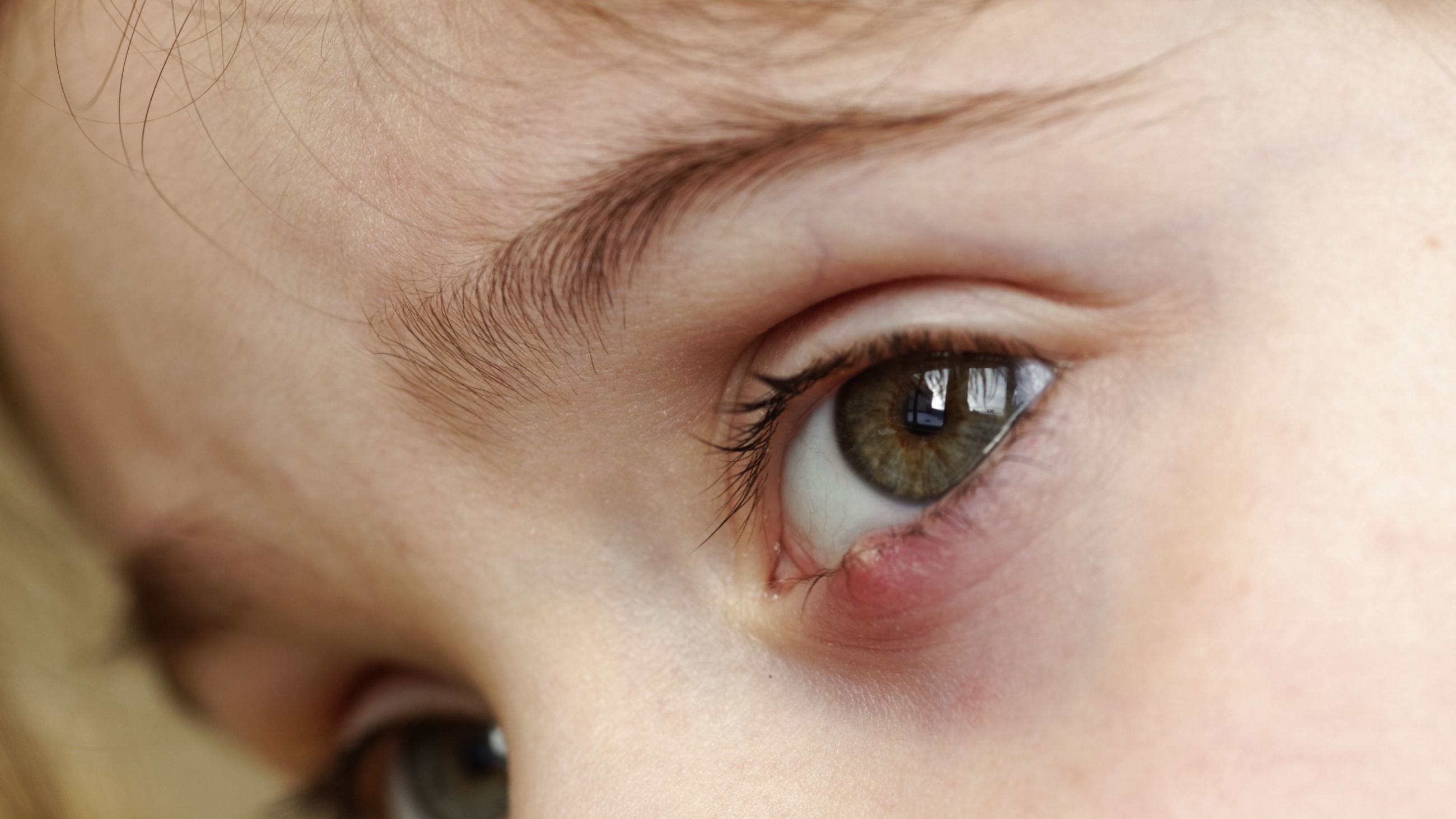 Close up of a child's eye with a stye