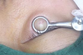 Close-up image of a lower eyelid being prepared for stye removal