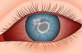 illustration of Acanthamoeba keratitis