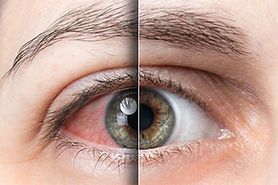 Red, sunburned eye versus healthy eye.