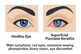 illustration showing the difference between a healthy eye and an eye with Superficial Punctate Keratitis