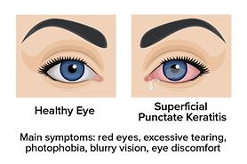 illustration showing the difference between a healthy eye and an eye with Superficial Punctate Keratitis