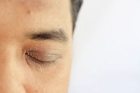 closeup of eyelids with dry skin