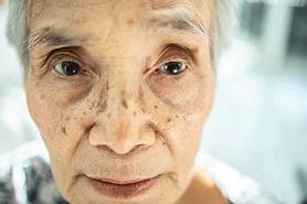 elderly woman with sunken eyes